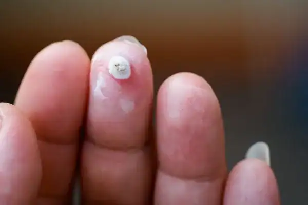 Image of white wart before cryopen treatment Hounslow