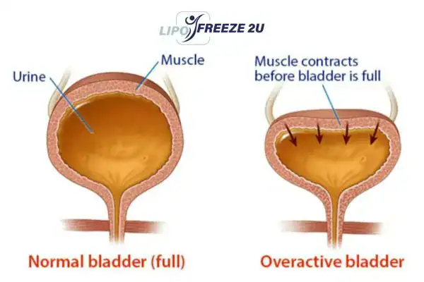 diagram of overactive bladder treatment Hounslow