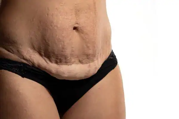 loose skin after weight loss injections Hounslow