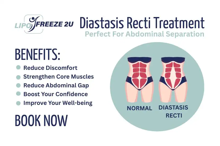 How Long Will It Take to See Improvements in Diastasis Recti Hounslow
