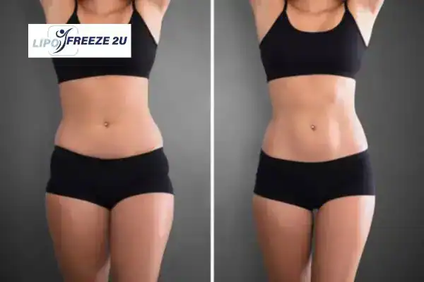 How Can LIPO FREEZE 2U Support Your Post-Pregnancy Body Recovery Hounslow?