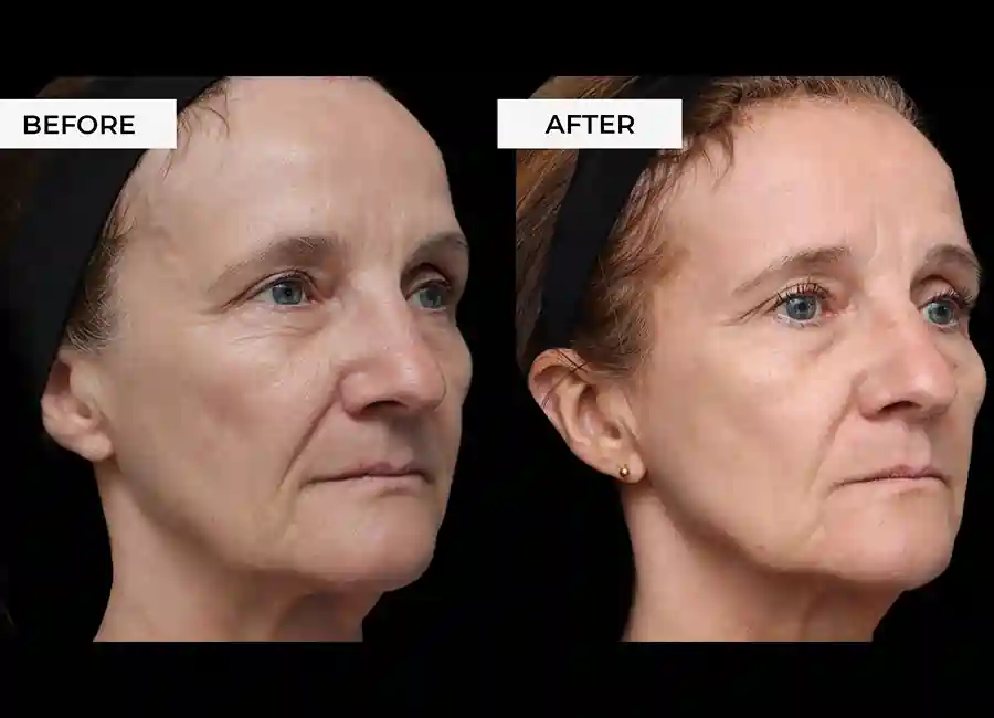 How Many RF Microneedling Sessions Will You Need to See a Difference Hounslow?