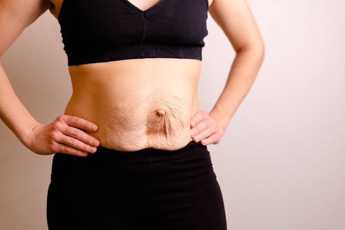 Is Surgery Really the Only Way to Repair Diastasis Recti Hounslow?