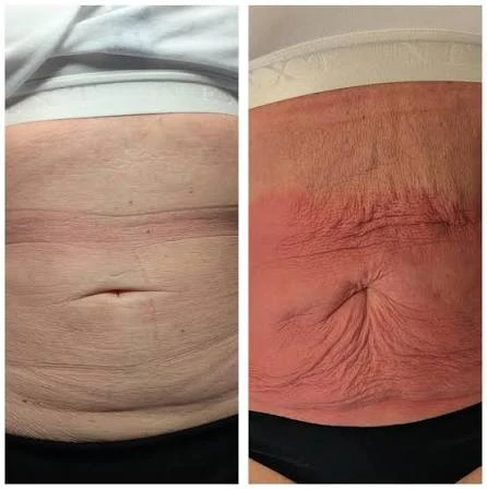 How Does RF Microneedling Improve Crepey, Thin and Uneven Skin Texture Hounslow?