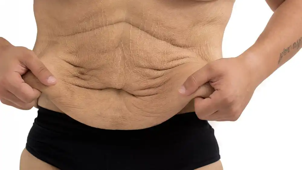 RF Microneedling for Loose Skin: How Can It Help Tighten and Reshape the Skin Hounslow?